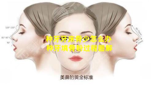 种牙牙床骨少怎么办 种牙填骨粉过程图解